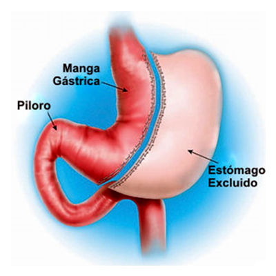 Gastroplastia Tubular